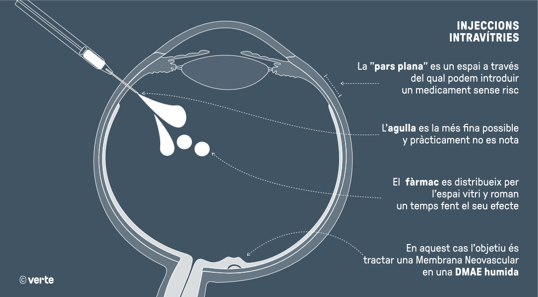 Injeccions intravítries - VERTE Oftalmologia Barcelona