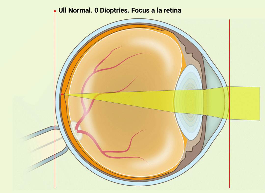 Miopia - Exemple -20 dioptries - VERTE Oftalmologia Barcelona
