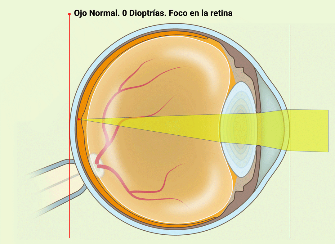 Miopía - Ejemplo -8 dioptrías - VERTE Oftalmología Barcelona