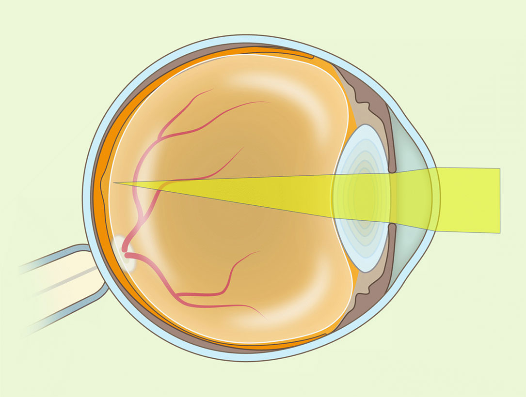 Qué es la Miopía y como tratarla