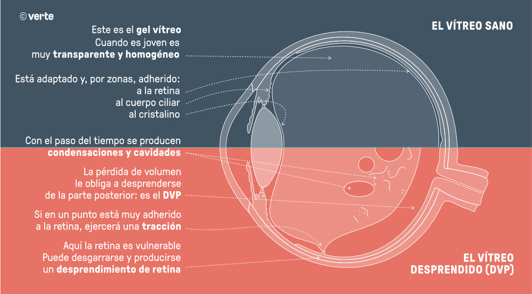 Moscas Volantes - Desprendimiento Vítreo Posterior - VERTE Oftalmología Barcelona