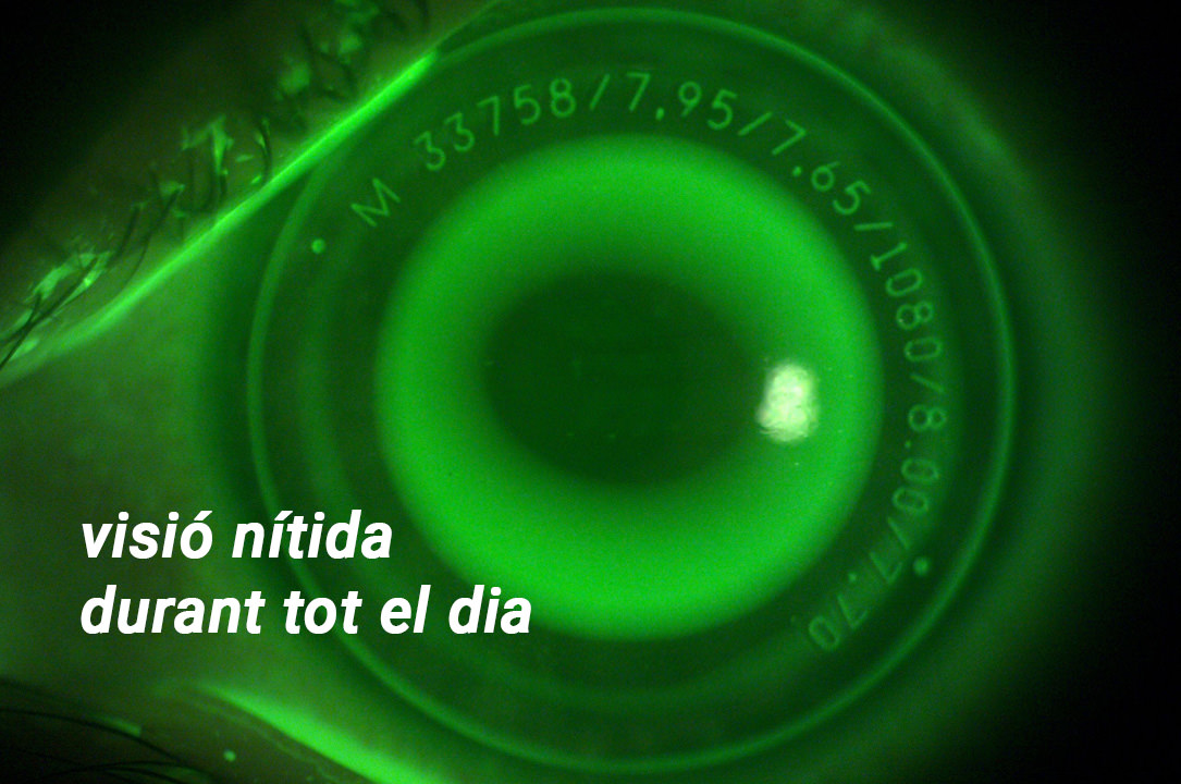 Orto-K - Miopia - VERTE Oftalmologia Barcelona