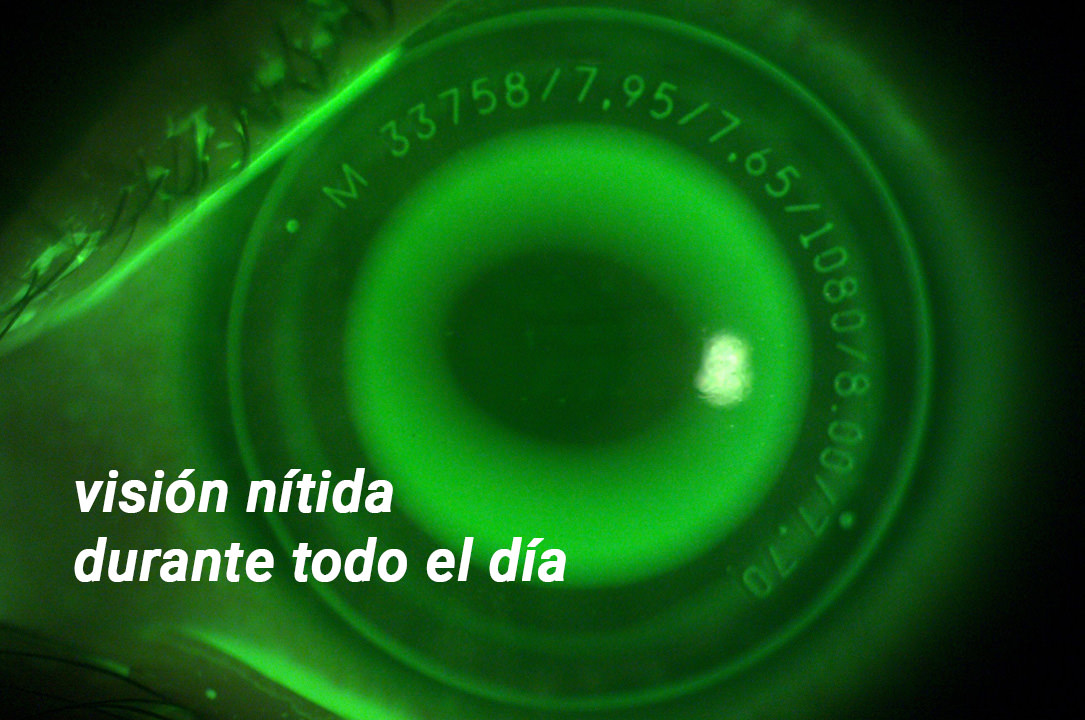 Orto-K - Miopía - VERTE Oftalmología Barcelona