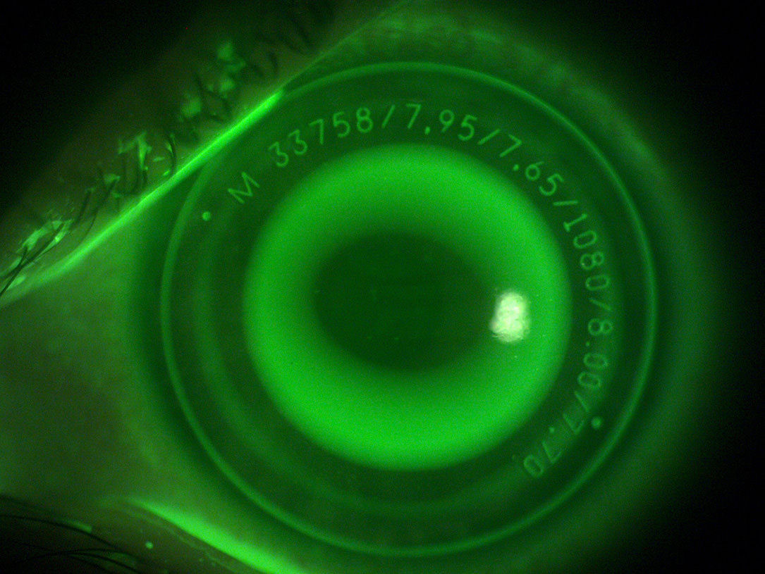 Orto-K - Ortoqueratologia