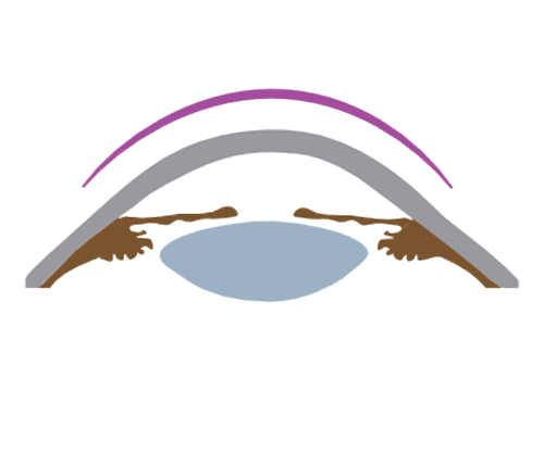 Orto K - VERTE Oftalmología Barcelona