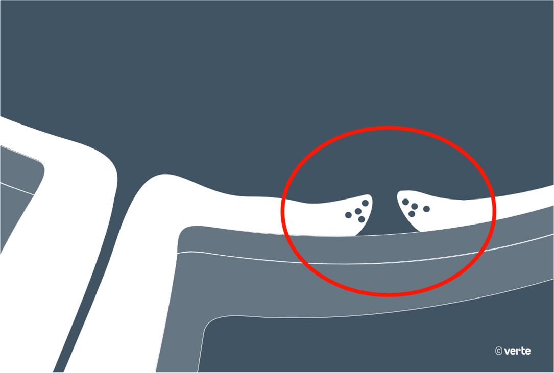 5 claves en la cirugía de la mácula - VERTE Oftalmología Barcelona