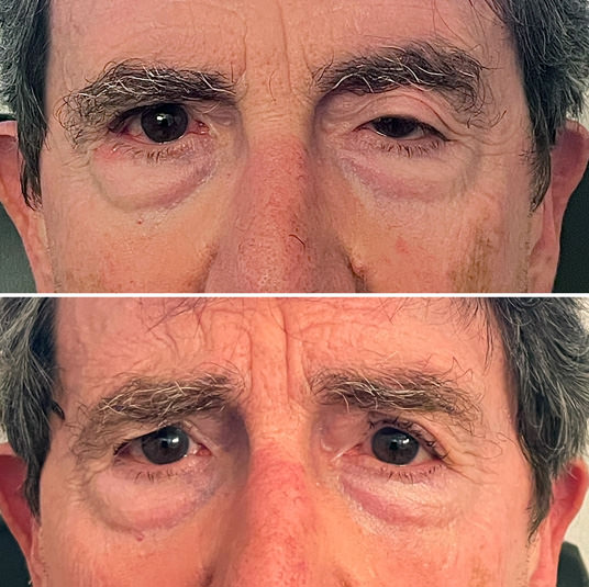 Ptosis - Proceso quirúrgico - VERTE Oftalmoogía Barcelona