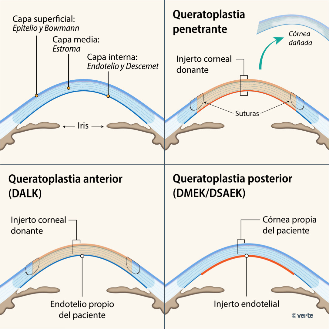 Trasplante de Córnea - Queratoplastia - VERTE Oftalmología Barcelona