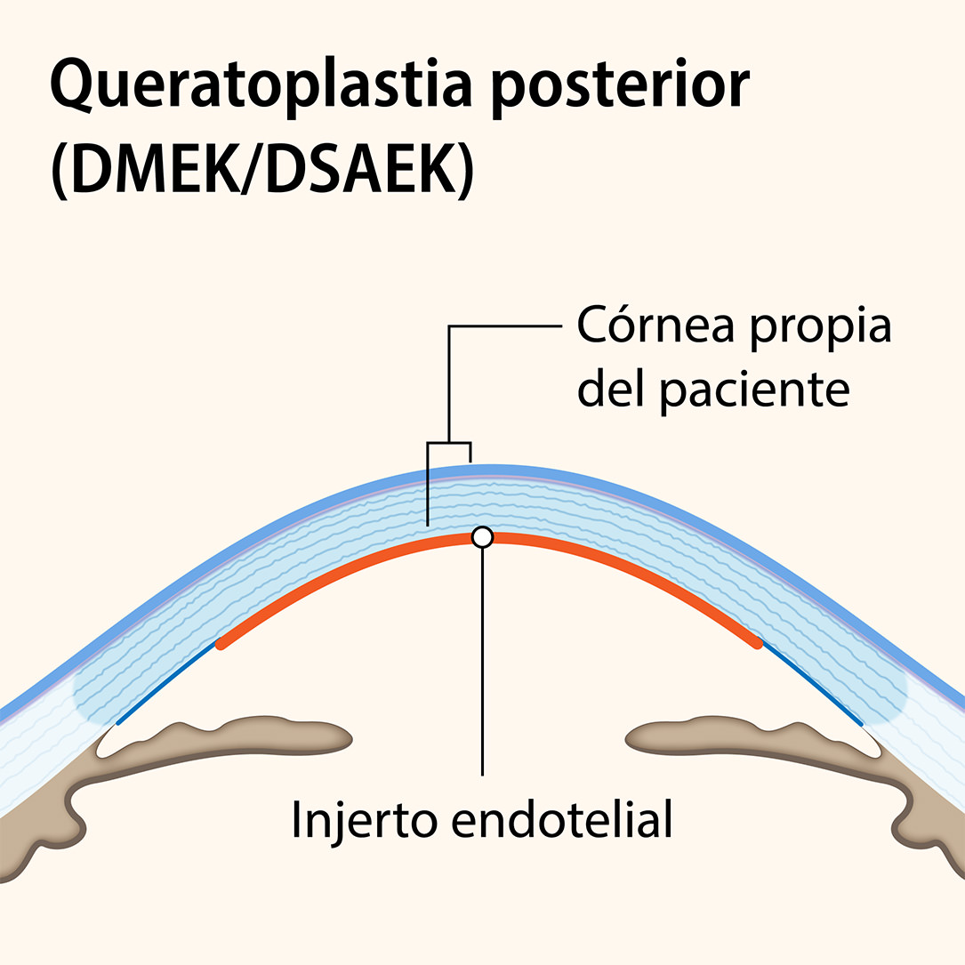Queratoplastia - Córnea - VERTE Oftalmología Barcelona
